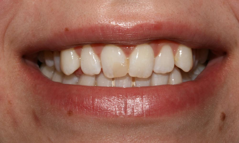 Before smile makeover showing staining on the front teeth of patient