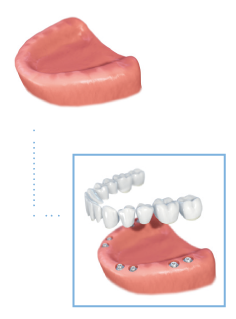 Full arch implants graphic