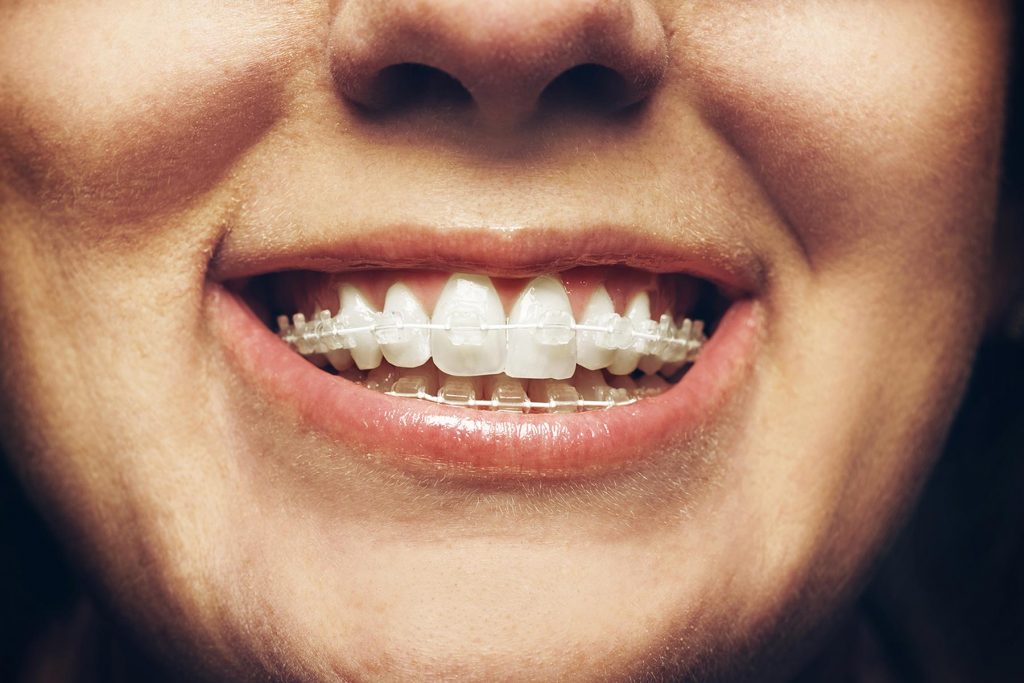 Six Month Smiles braces fitted to smiling patient