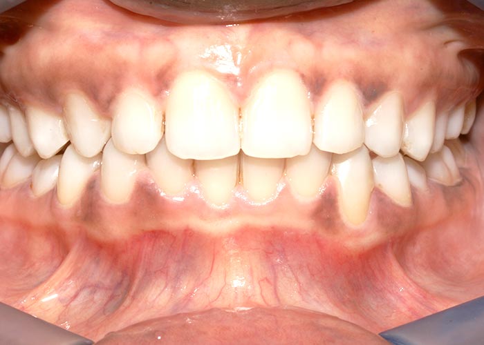 After orthodontics picture showing straight, clean teeth