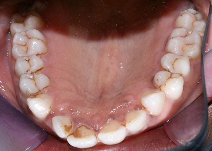 Crooked bottom row of teeth before lingual orthodontic treatment