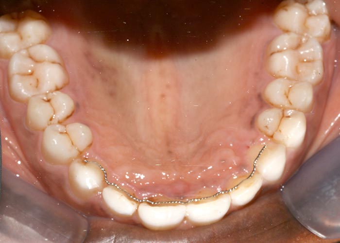 Lingual braces fitted to the back of bottom row of straightened teeth