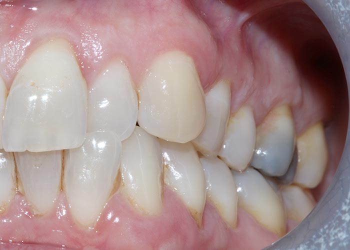Before orthodontic treatment of misaligned and overcrowded teeth