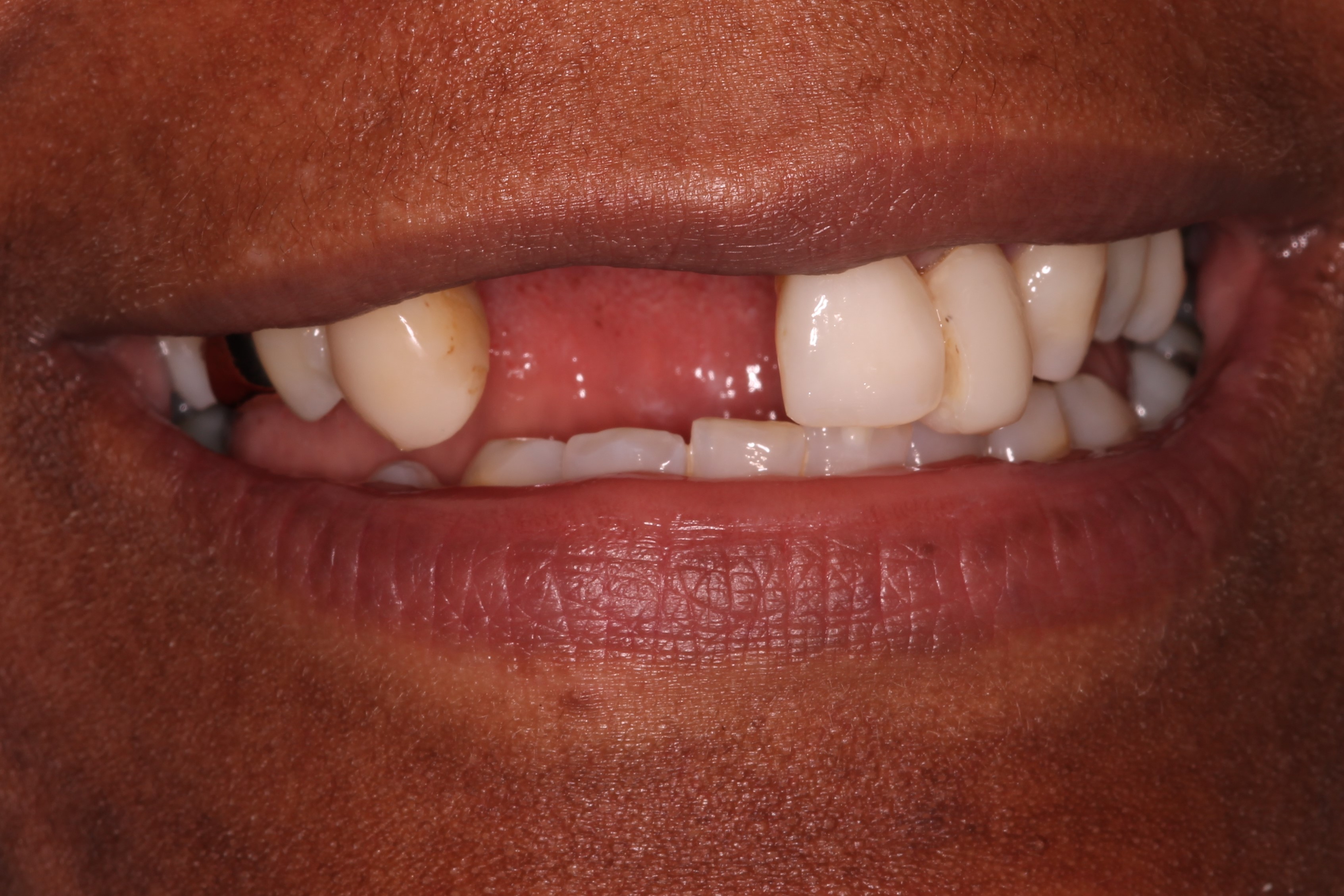 patient with two missing teeth before dental implant treatment