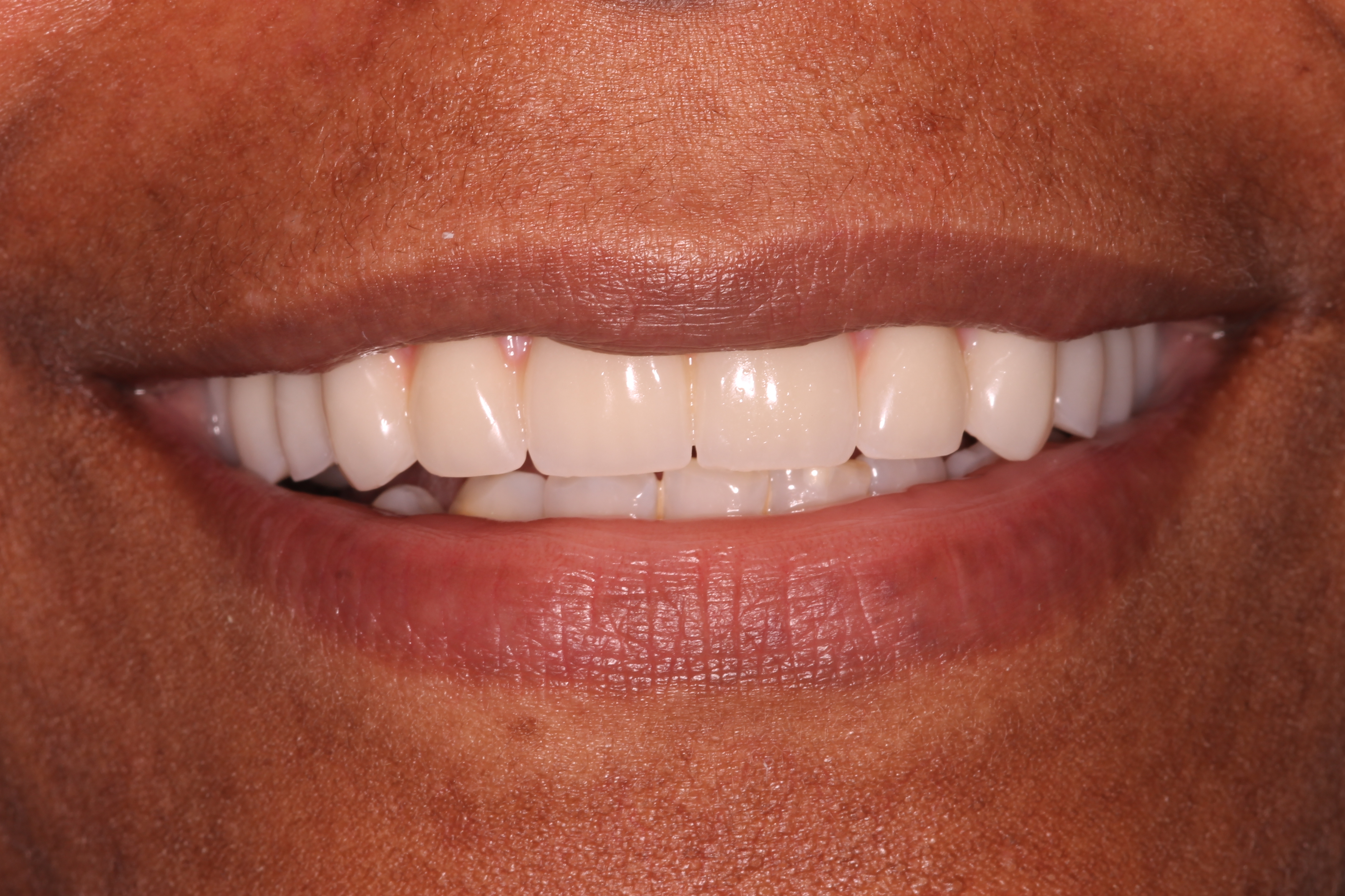 patient smiling after dental implant treatment