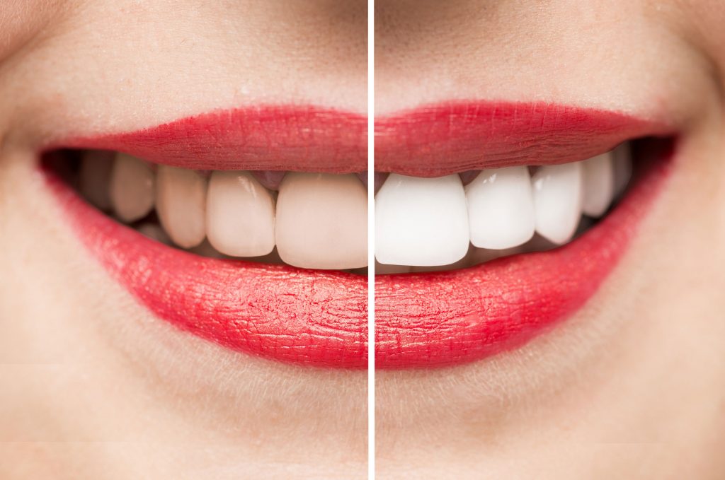 Showing teeth before and after whitening
