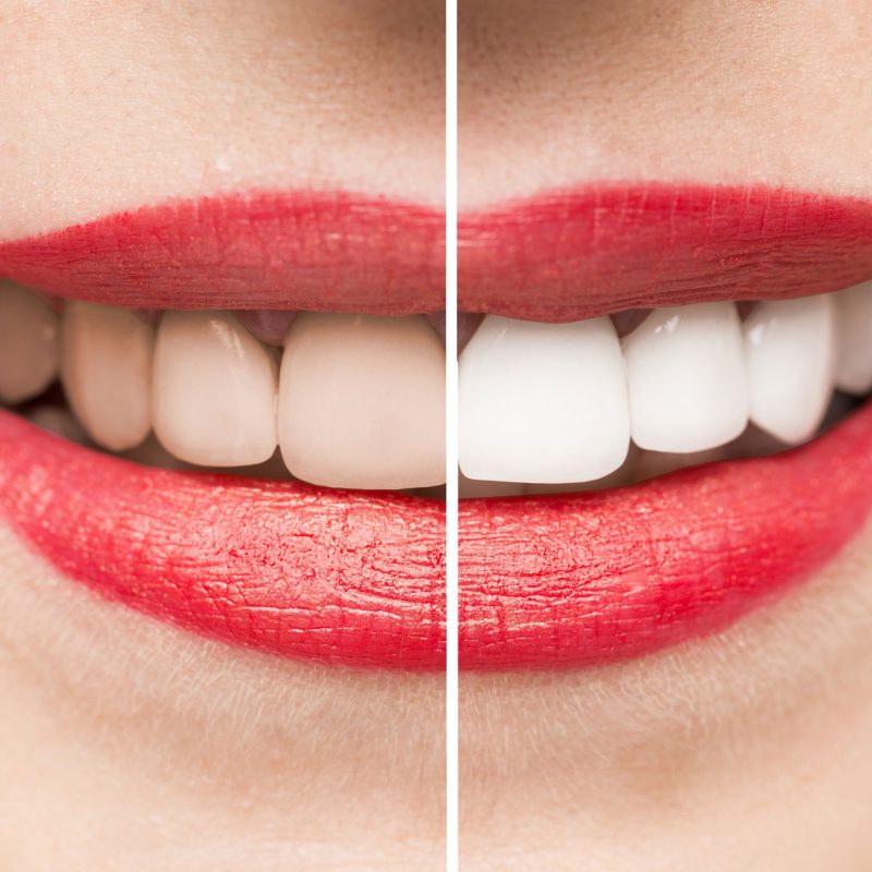 Showing teeth before and after whitening