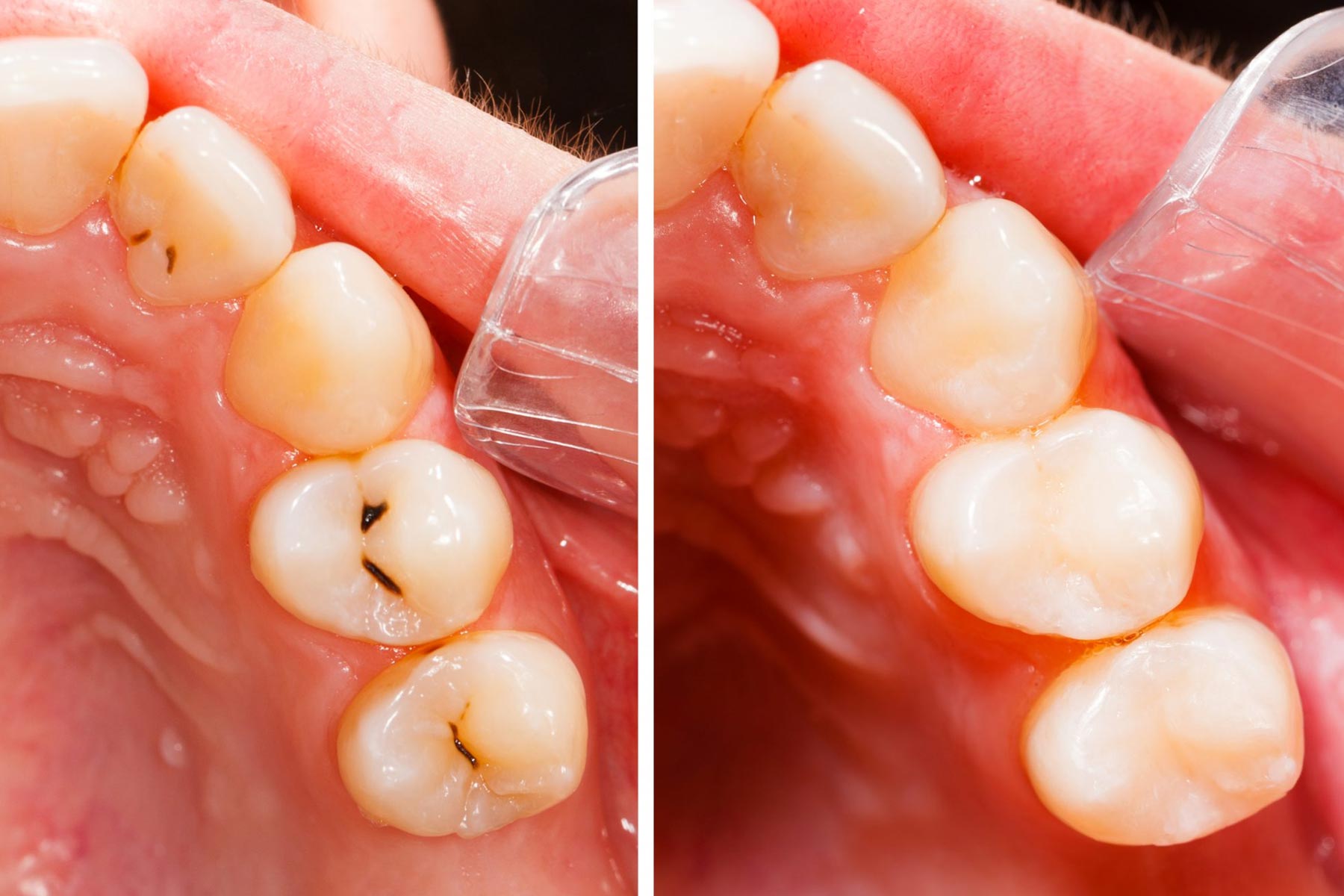 White fillings before and after pictures