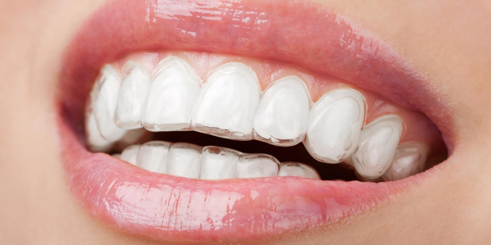 Here’s what YOU need to know about Invisalign
