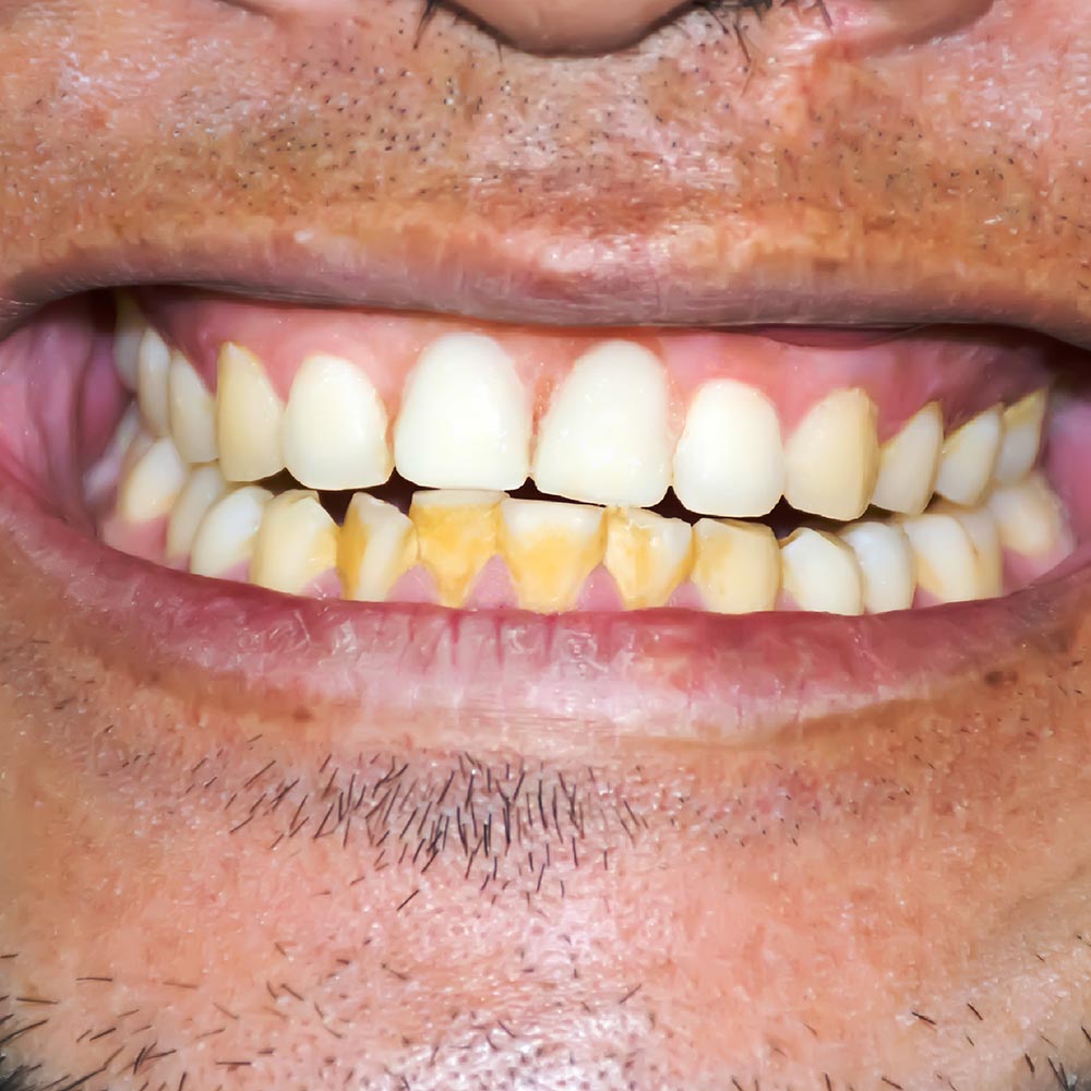 How to remove stains from your teeth cosmetic dentistry in Wiltshire