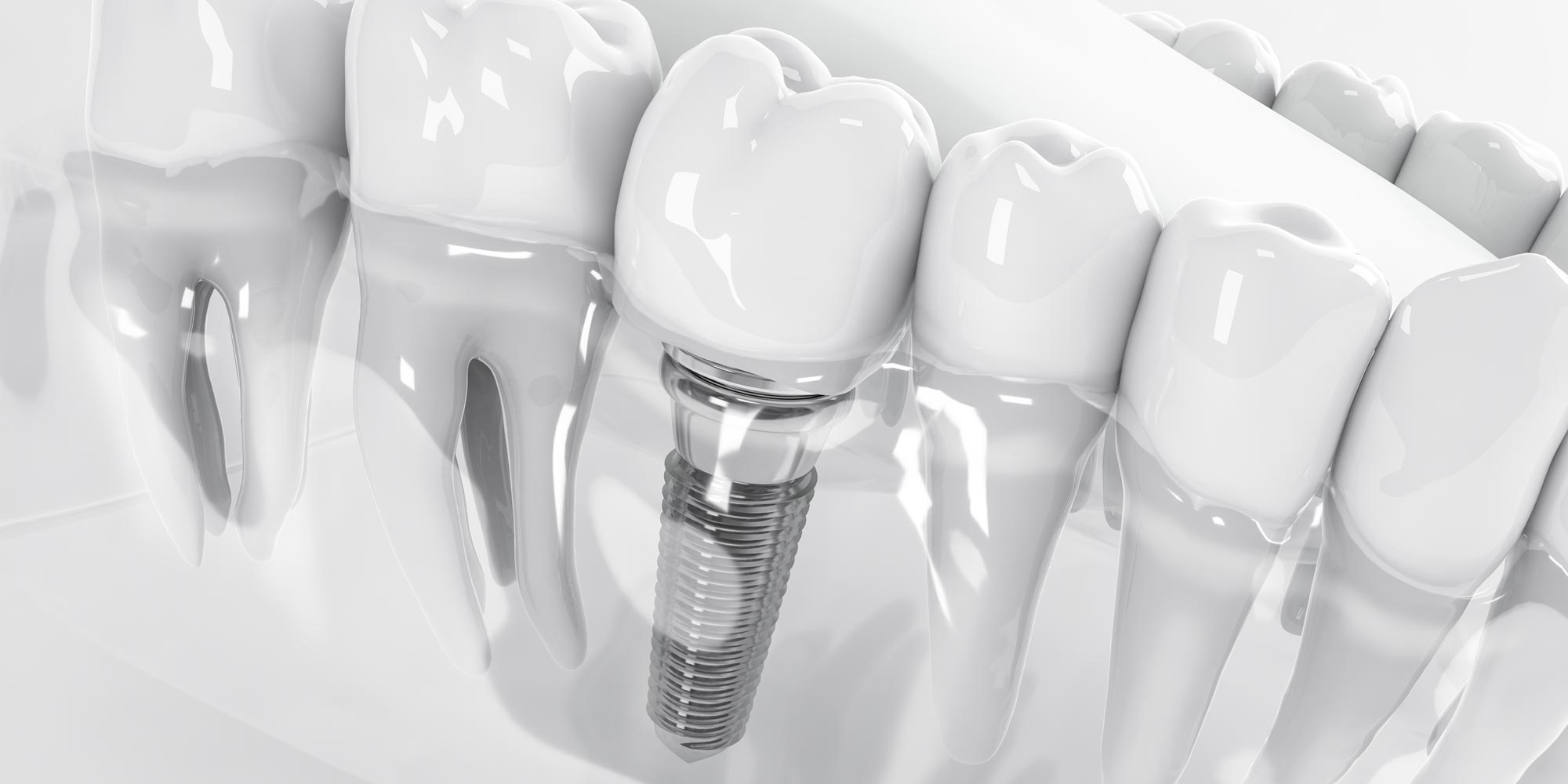 Missing or damaged teeth? Here’s what dental implants can do for you!