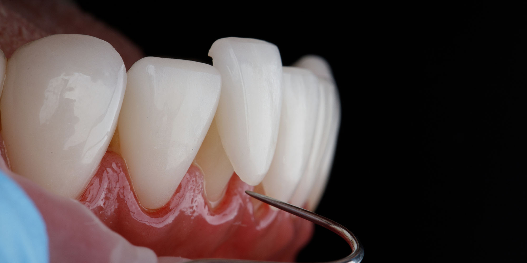 Affordable Porcelain Veneers in Salisbury, Wiltshire